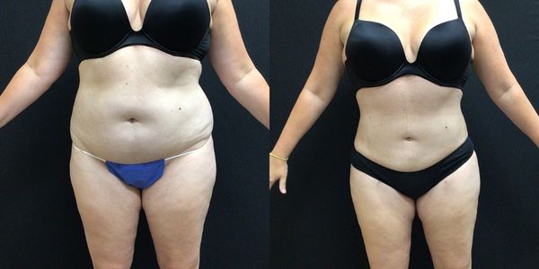 Liposuction Before and After Patient 144 3