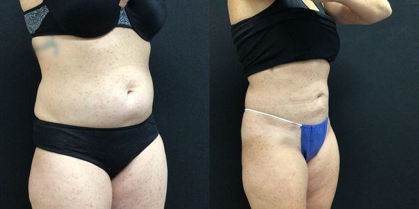 Liposuction Before and After Patient 145 3