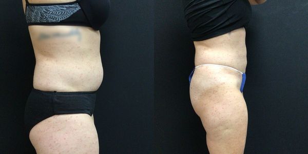 Liposuction Before and After Patient 145 2