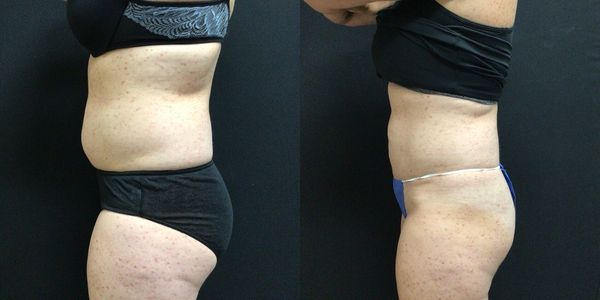 Liposuction Before and After Patient 145