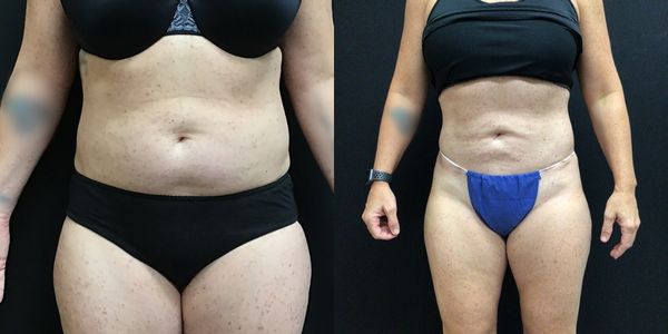 Liposuction Before and After Patient 145 4