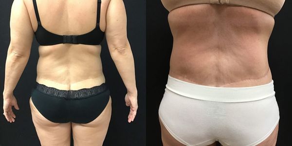 Liposuction Before and After Patient 174 4