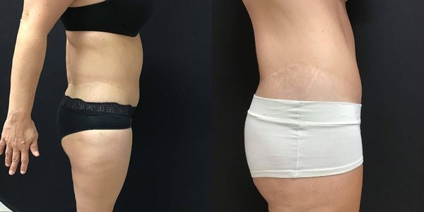 Liposuction Before and After Patient 174 3