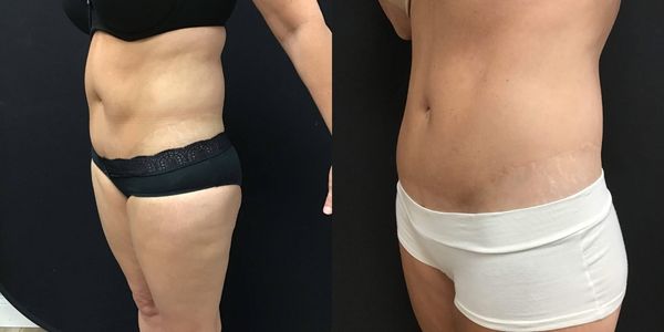 Liposuction Before and After Patient 174 2