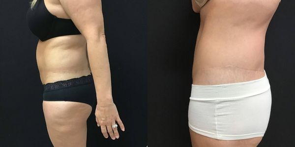 Liposuction Before and After Patient 174