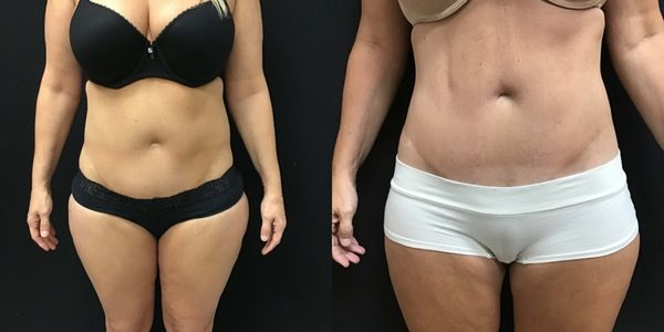 Liposuction Before and After Patient 174 5
