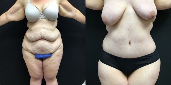 Liposuction Before and After Patient 179 4