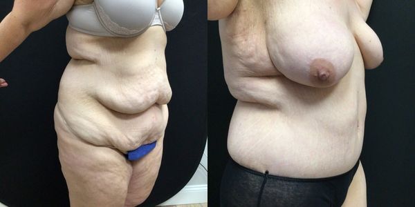 Liposuction Before and After Patient 179 3