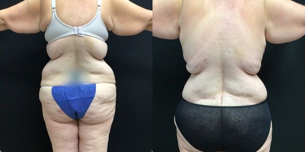Liposuction Before and After Patient 179 2