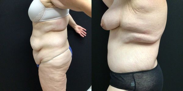 Liposuction Before and After Patient 179