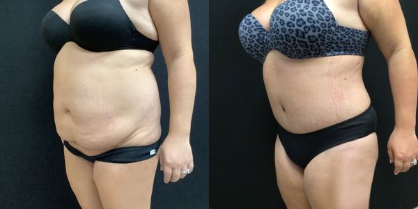 Liposuction Before and After Patient 182 2