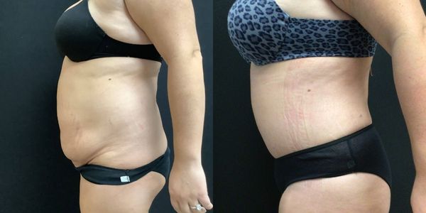 Liposuction Before and After Patient 182