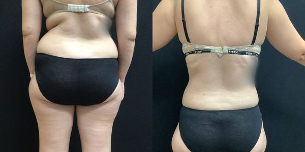 Liposuction Before and After Patient 183 3