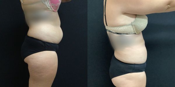 Liposuction Before and After Patient 183