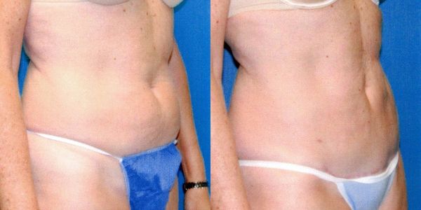 Liposuction Before and After Patient 19 3