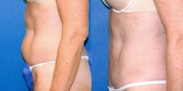 Liposuction Before and After Patient 19 2