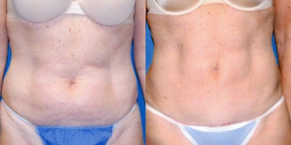 Liposuction Before and After Patient 19