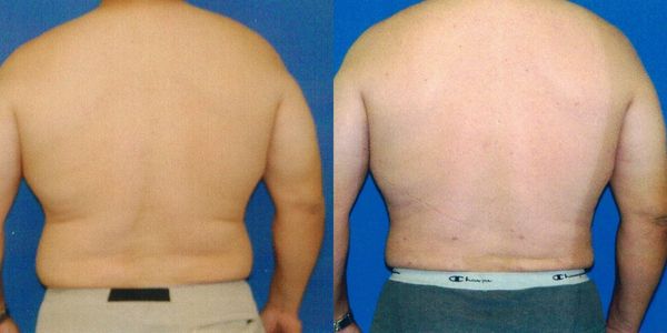 Liposuction Before and After Patient 20 3