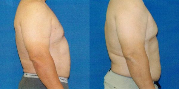 Liposuction Before and After Patient 20 2