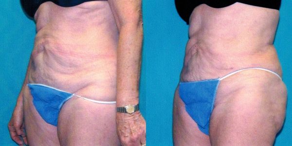 Liposuction Before and After Patient 21 3