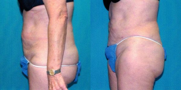 Liposuction Before and After Patient 21 2