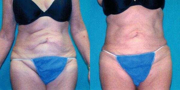 Liposuction Before and After Patient 21