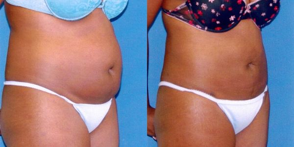 Liposuction Before and After Patient 22 2