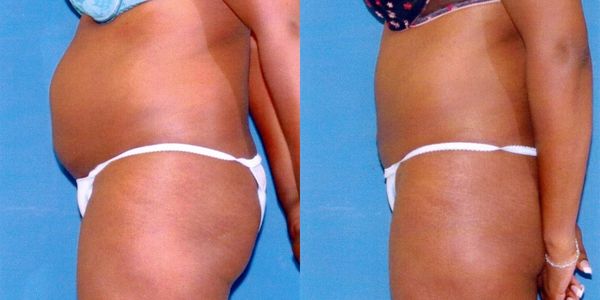Liposuction Before and After Patient 22