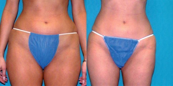 Liposuction Before and After Patient 23