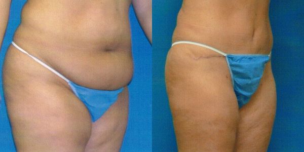 Liposuction Before and After Patient 24 3
