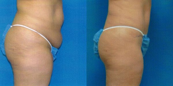 Liposuction Before and After Patient 24 2