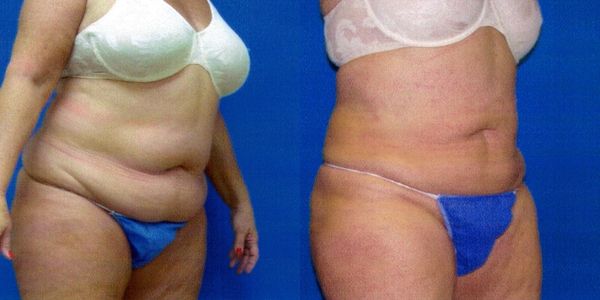 Liposuction Before and After Patient 27 2