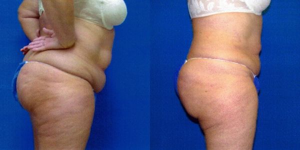 Liposuction Before and After Patient 27