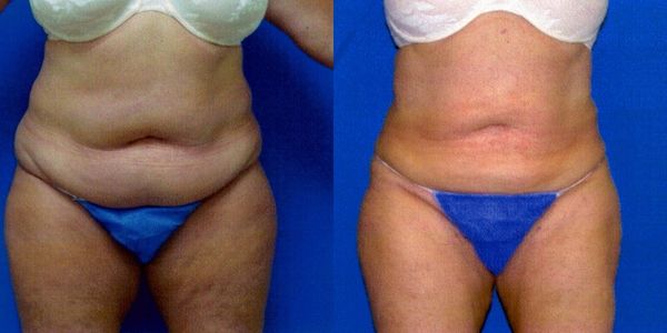 Liposuction Before and After Patient 27 3