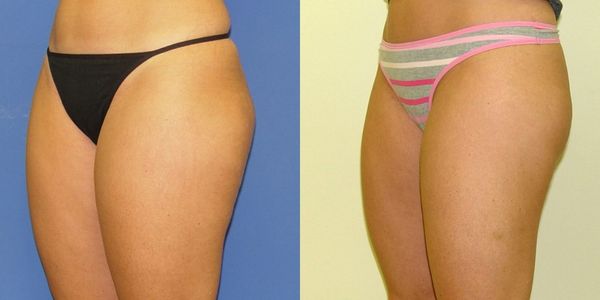 Liposuction Before and After Patient 31 3
