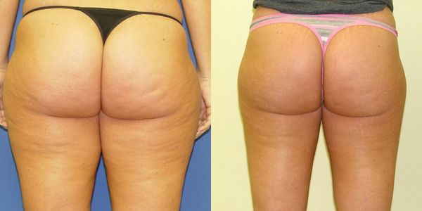 Liposuction Before and After Patient 31 2