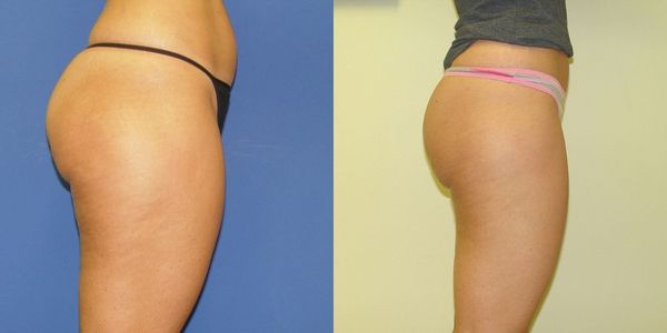 Liposuction Before and After Patient 31