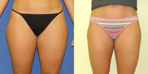 Liposuction Before and After Patient 31 4