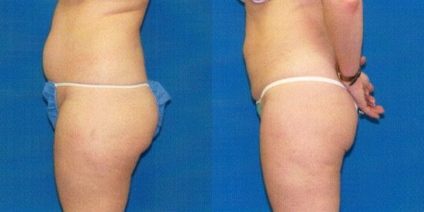 Liposuction Before and After Patient 82
