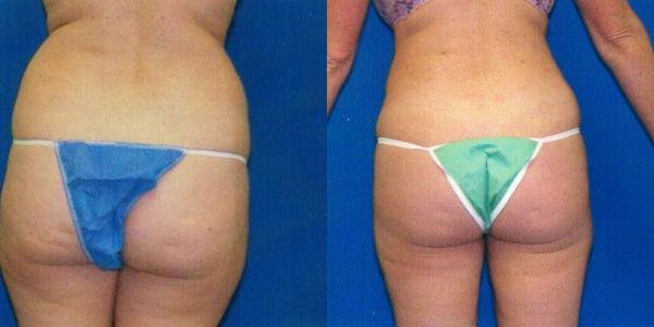 Liposuction Before and After Patient 82 5