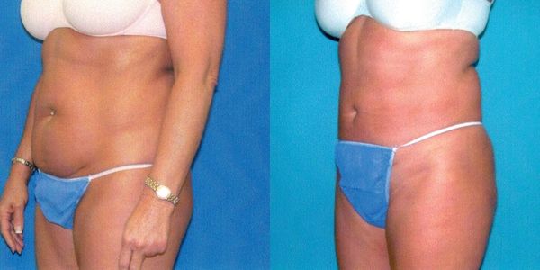 Liposuction Before and After Patient 83 2