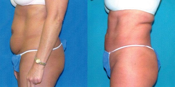 Liposuction Before and After Patient 83