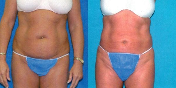 Liposuction Before and After Patient 83 3