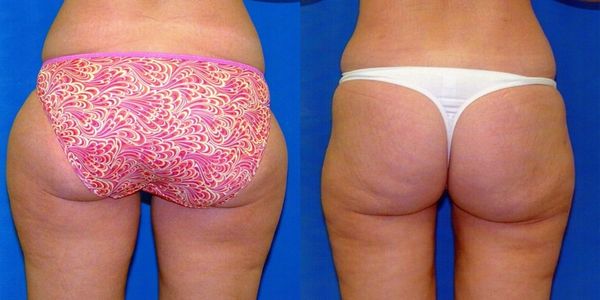 Liposuction Before and After Patient 84