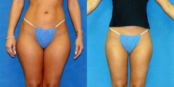 Liposuction Before and After Patient 85