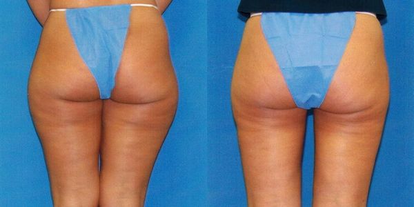Liposuction Before and After Patient 85 (2)