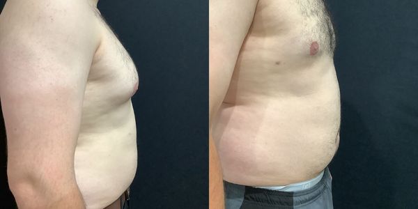 Male Breast Reduction Before and After Patient 146 2