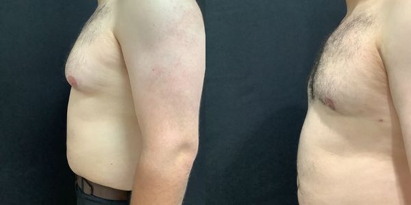 Male Breast Reduction Before and After Patient 146