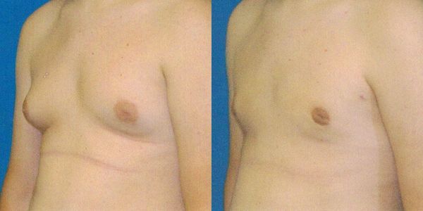 Male Breast Reduction Before and After Patient 80 (2)
