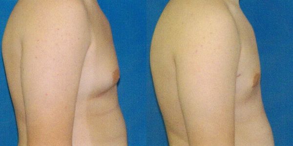 Male Breast Reduction Before and After Patient 80 (3)